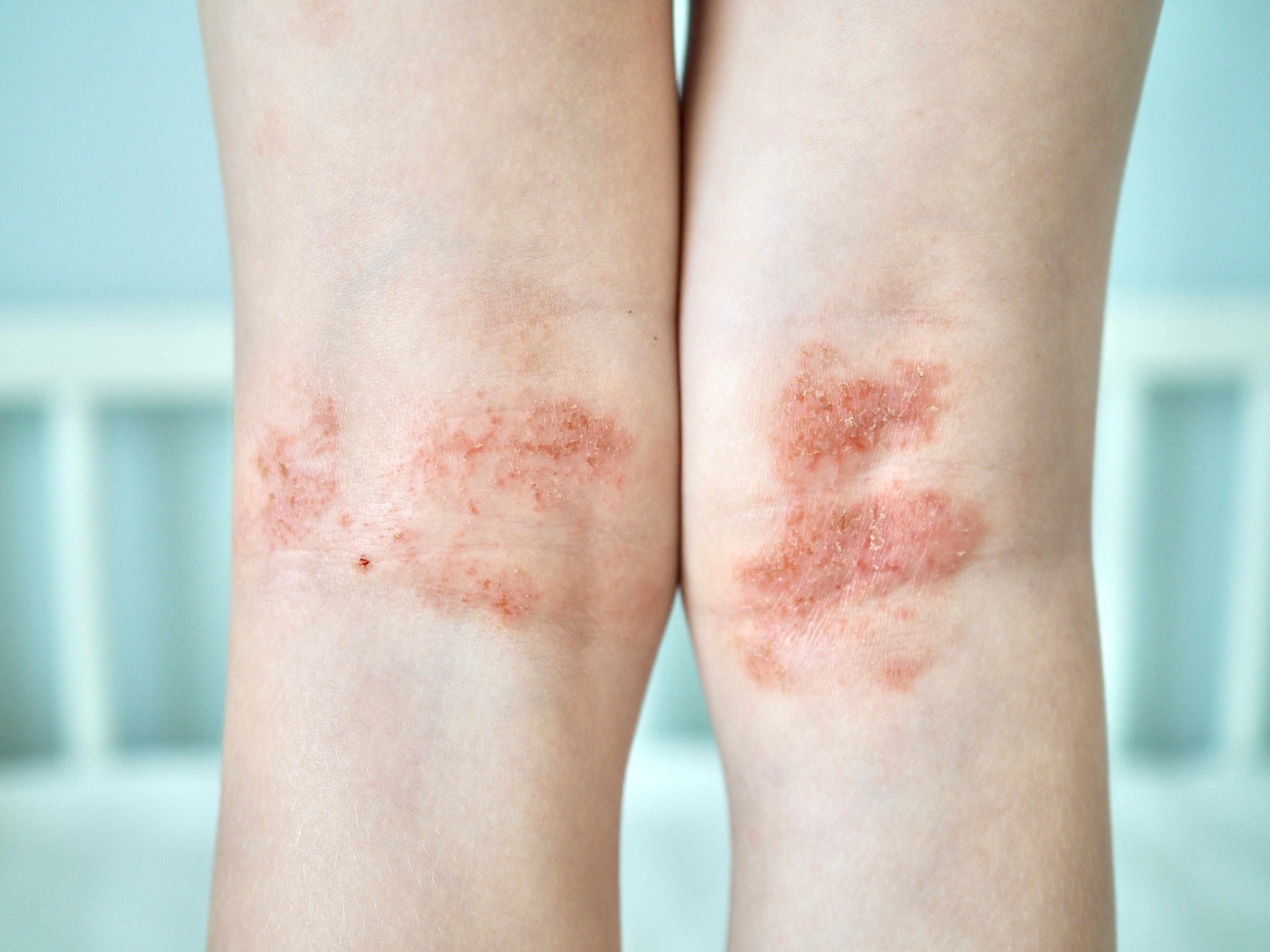 psoriasis-inversa-schuppenflechte-in-hautfalten-behandeln
